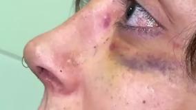 قبل و بعد عمل انحراف بینی در درمانگاه مسیح