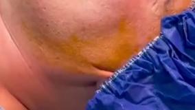 عمل بینی بدون بیهوشی مردانه در کلینیک مسیح