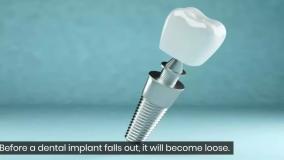 از ایمپلنتت صدای کلیک میاد؟ این ویدیو رو ببین!