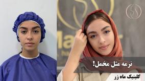 ✨ خداحافظی با جای جوش در یک جلسه ۴ ساعته! ( کلینیک ماه زر )
