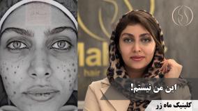 وقتی نتیجه بعد از یک جلسه خودش حرف میزنه… ✨ ( کلینیک زیبایی ماه زر )