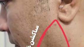 زاویه فک و ساکشن غبغب