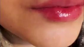 تزریق فیلر لب