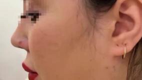 درمان ساکشن غبغب