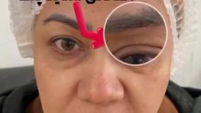 بلفاروپلاستی