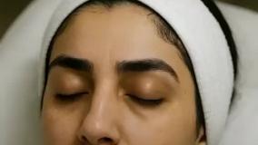 قبل و بعد تزریق فیلر لب