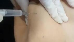 مزوتراپی شکم جهت لیپولیز بافت چربی