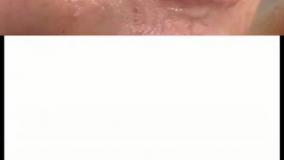 مقایسه قبل و بعد تزریق فیلر لب