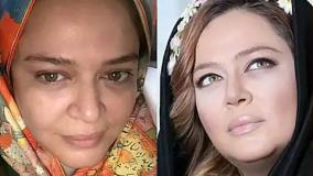 از لیپوتراپی تا بلفاروپلاستی؛ جراحی‌های زیبایی محبوب در بین بازیگران