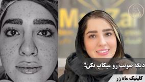 از بین بردن منافذ باز صورت در یک جلسه✨ ( کلینیک زیبایی ماه زر )