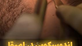 اندوسکوپی در امیقا