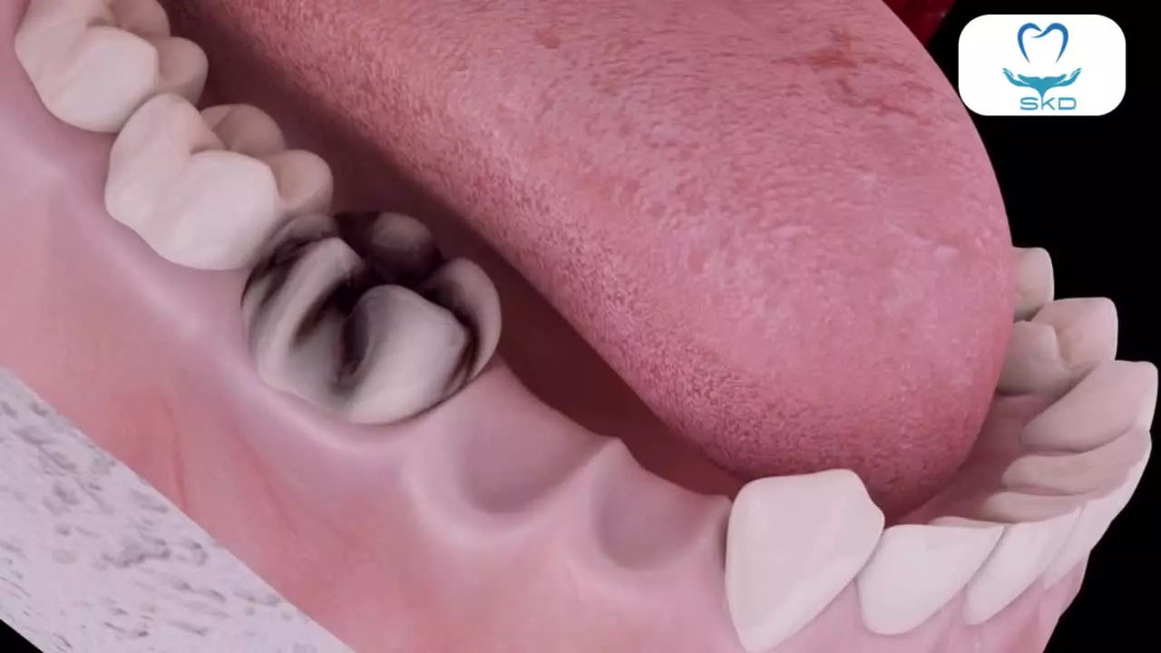 روکش دندان و ایمپلنت ترکیبی | سلامت کاشت درین