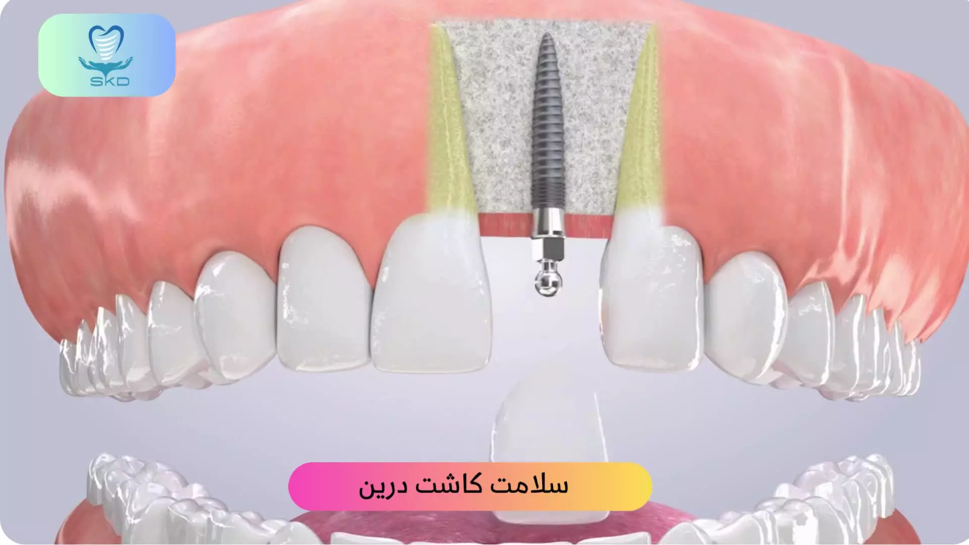 کاشت ایمپلنت برای دندان جلو |سلامت کاشت درین