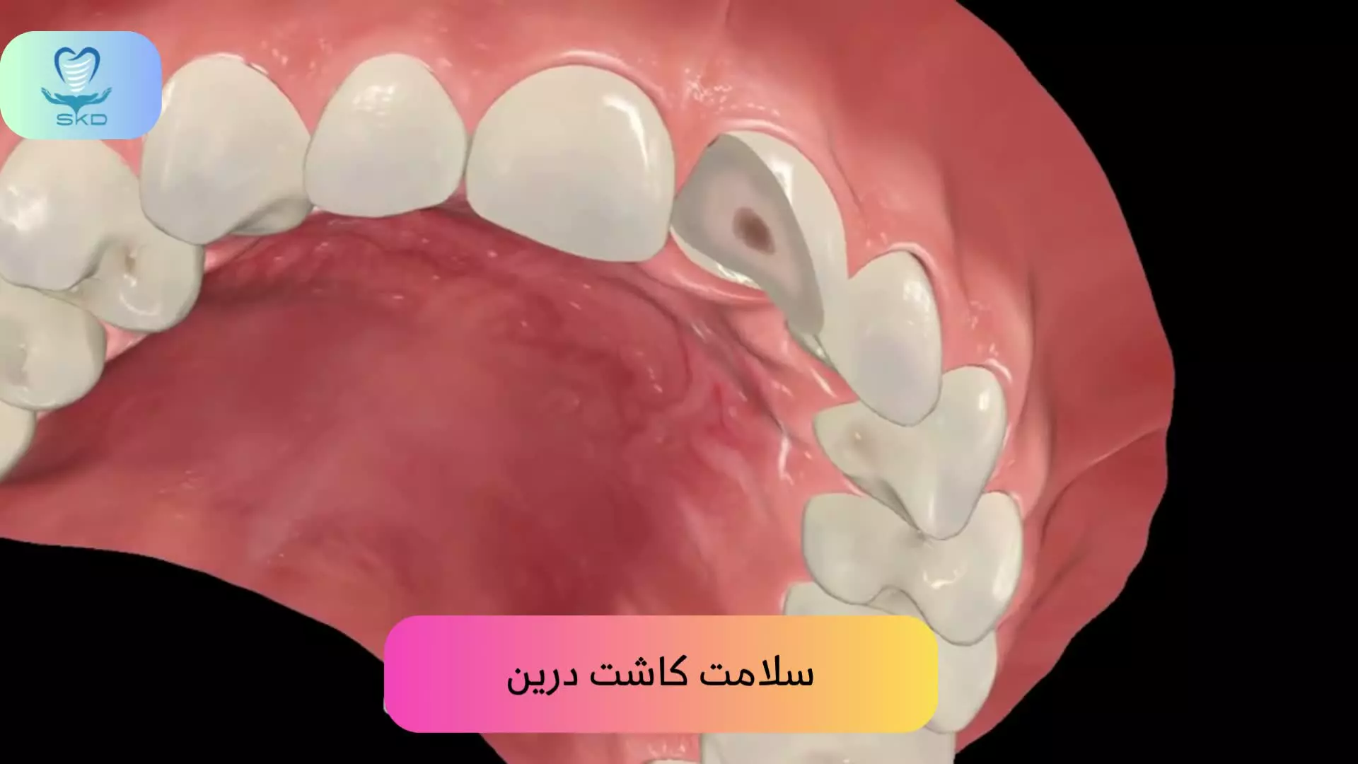 ایمپلنت دندان برای دندان‌های جلویی شکسته | سلامت کاشت درین