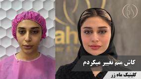 وقتی صحبت از فرم‌دهی صورت می‌شه! ( کلینیک زیبایی ماه زر )