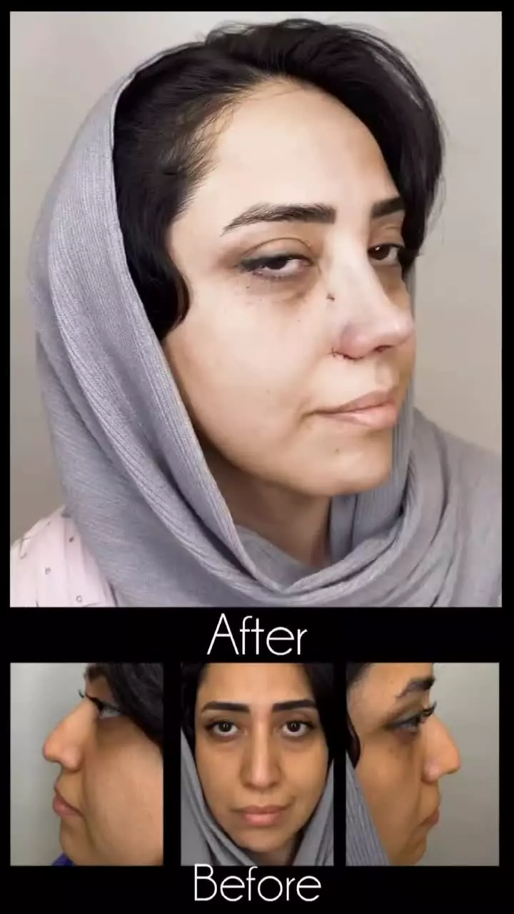 جراحی بینی بدون بیهوشی در کلینیک مسیح