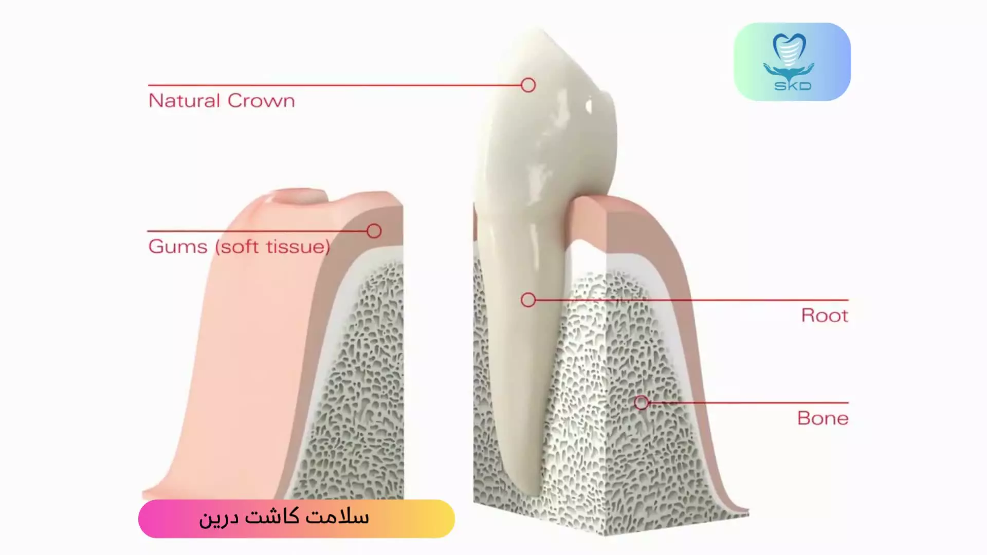 معرفی سیستم ایمپلنت دندانی | ایمپلنت دندان چیست؟ | سلامت کاشت درین
