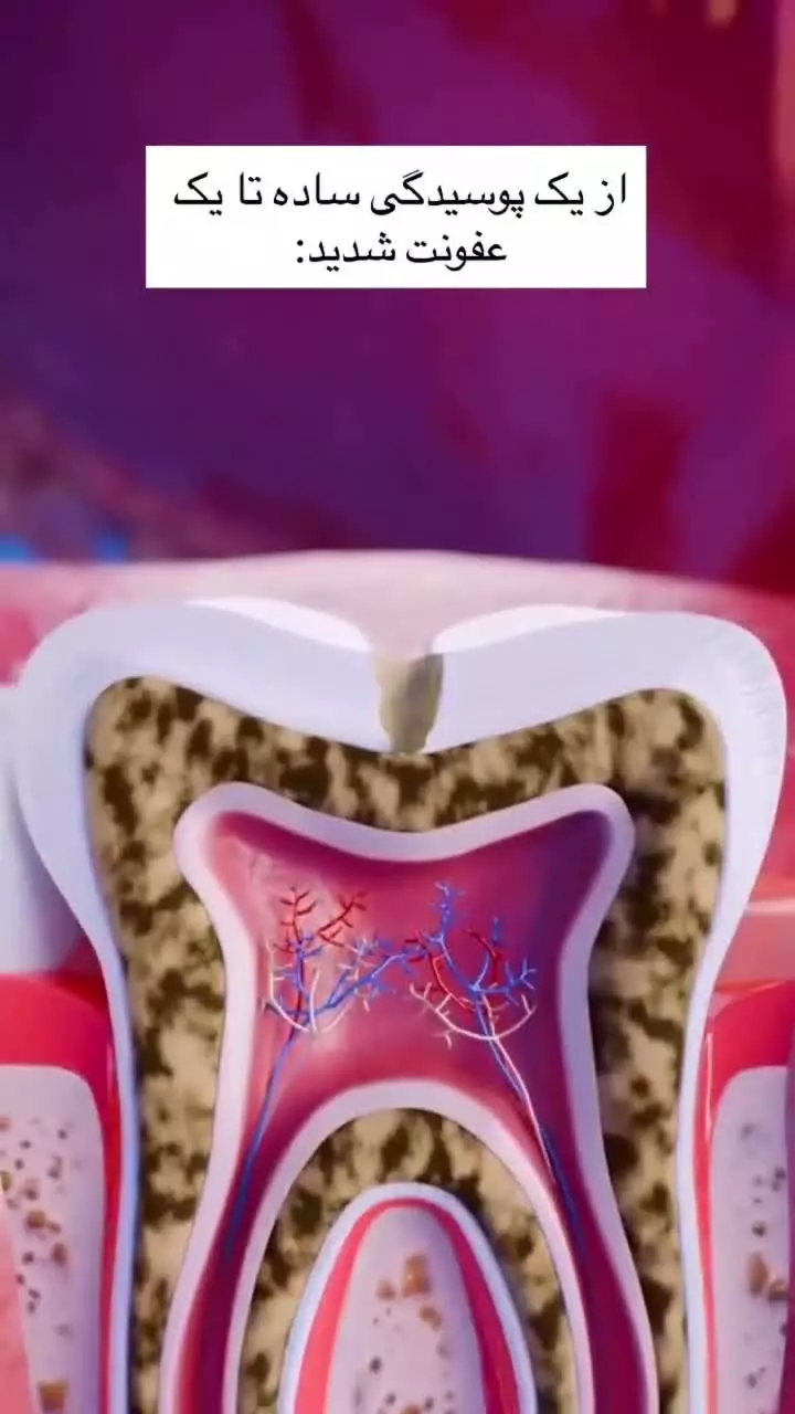 از پوسیدگی ساده تا یک عفونت شدید!
