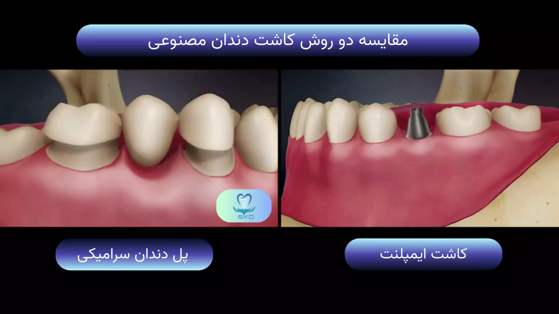 مقایسه پل دندان سرامیکی و ایمپلنت دندانی | سلامت کاشت درین