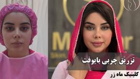 این روزها همه از گرونی فیلرها حرف می‌زنن