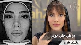 یک جلسه ۴ ساعته! ( کلینیک زیبایی ماه زر )