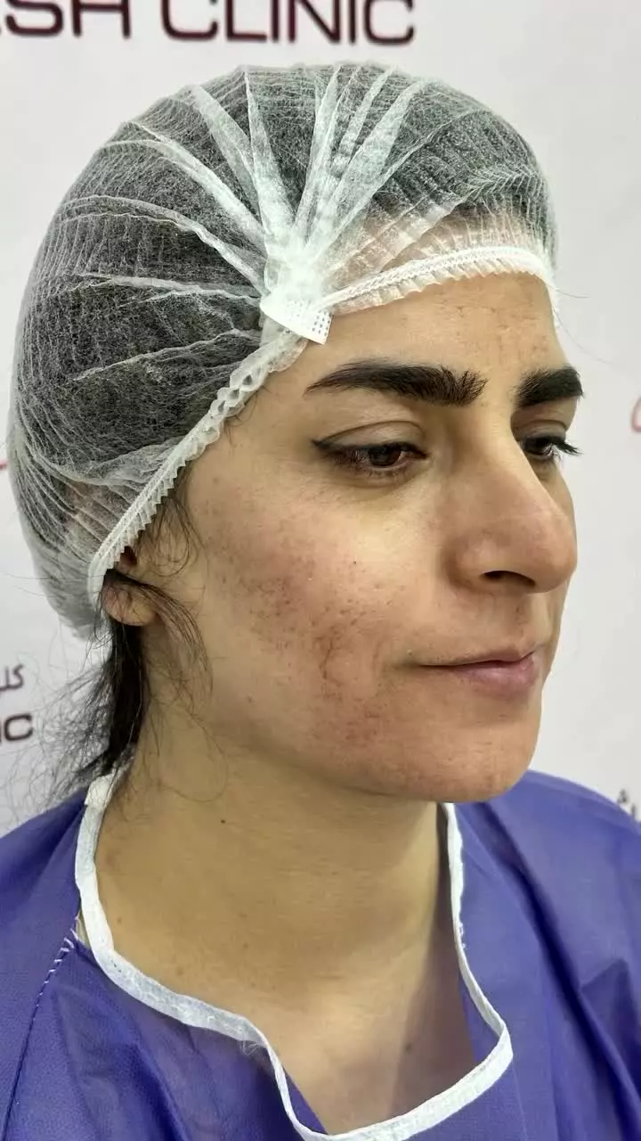 نمونه کار تیپ پلاستی نوک بینی در کلینیک مسیح