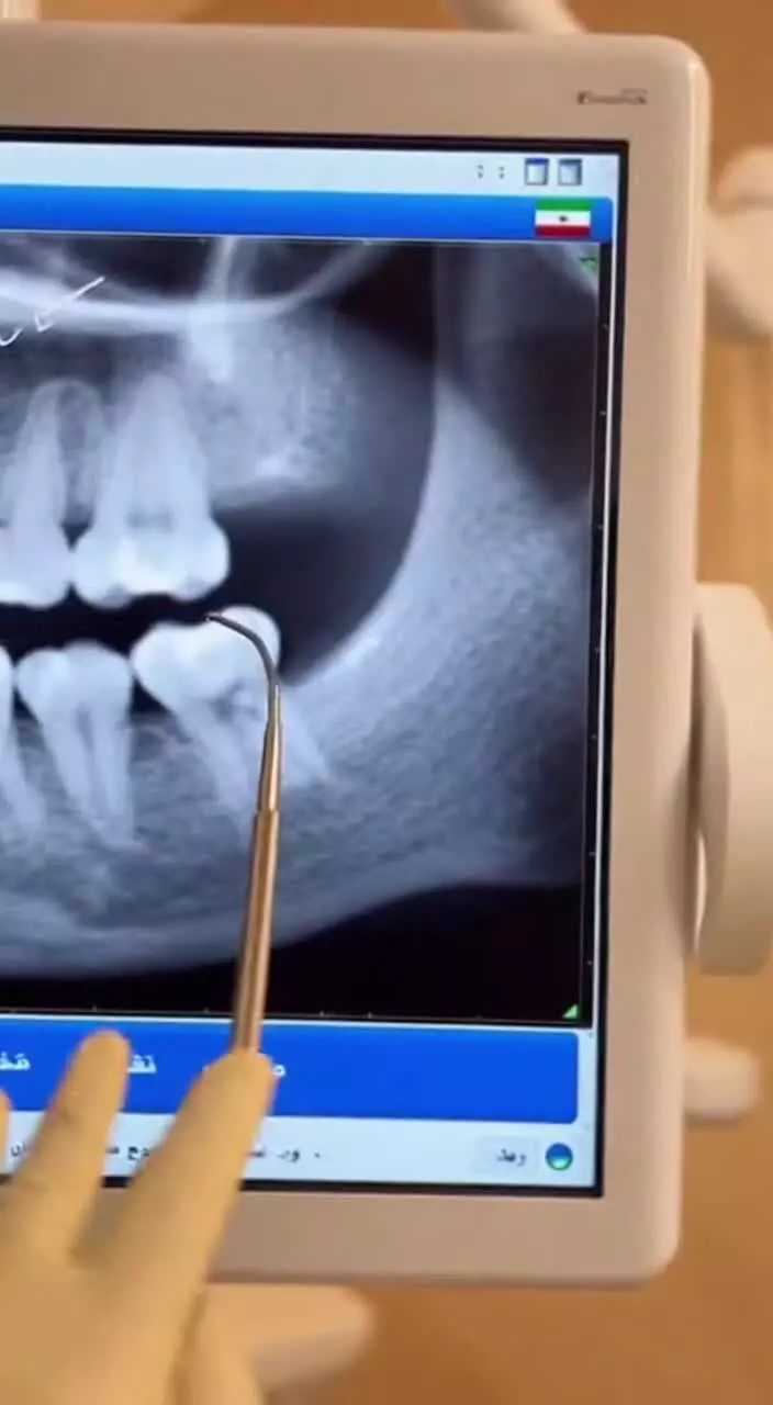 خداحافظی با دندان مصنوعی برای همیشه