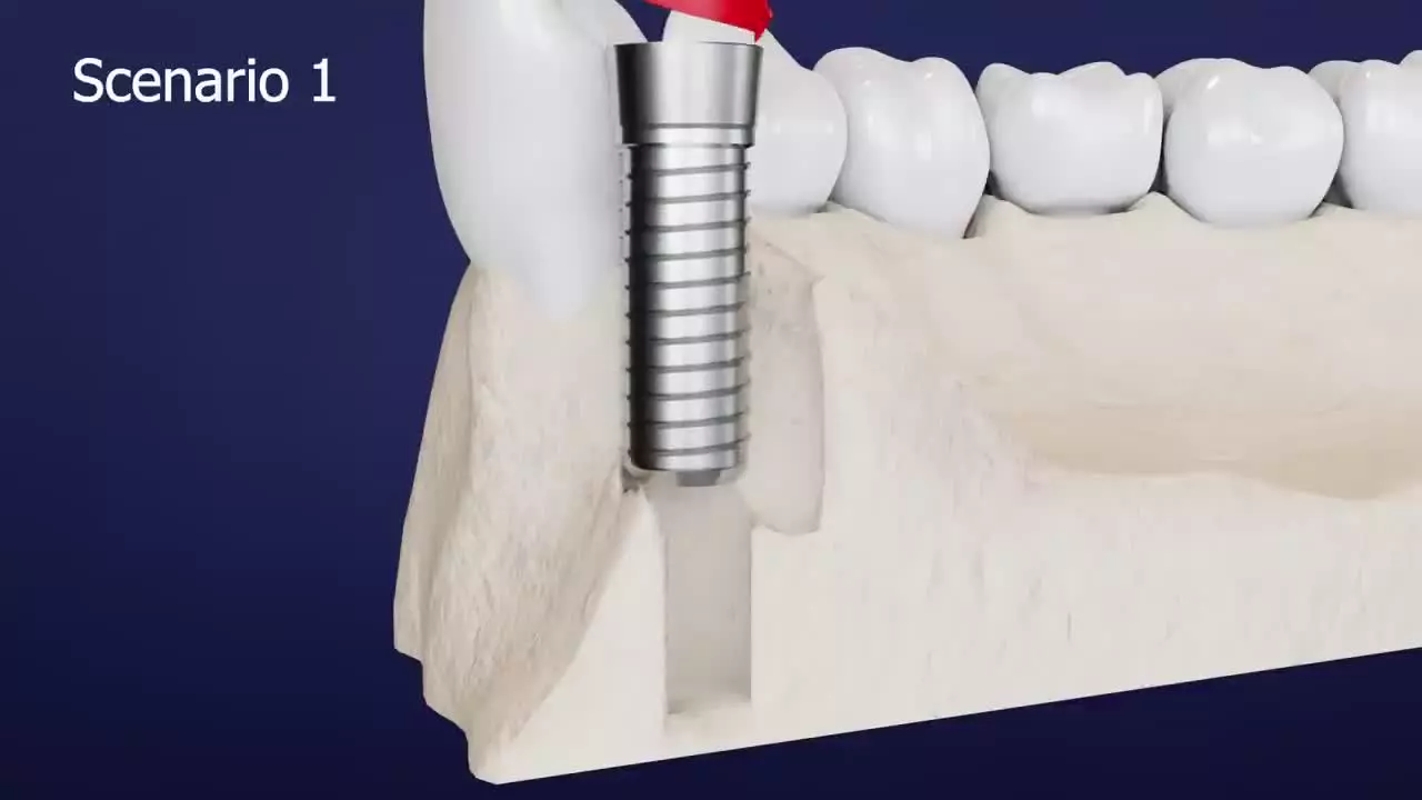 از اسکن دیجیتال تا پیوند استخوان؛ مسیر آماده‌سازی فک برای ایمپلنت