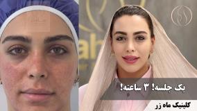 یک جلسه! ۳ ساعته ( کلینیک زیبایی ماه زر )