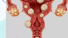 در مورد اندومتریوز چه می‌دانید؟
