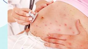 آبله مرغان در بارداری