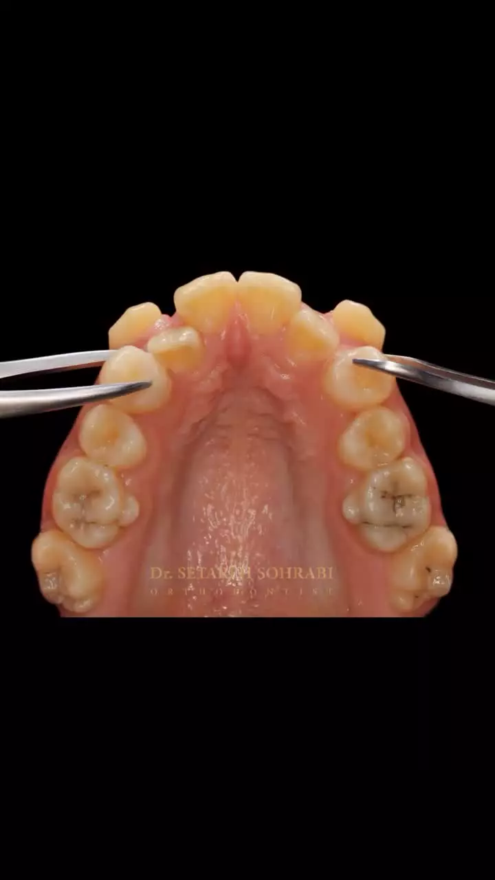 قبل و بعد ارتودنسی عالی