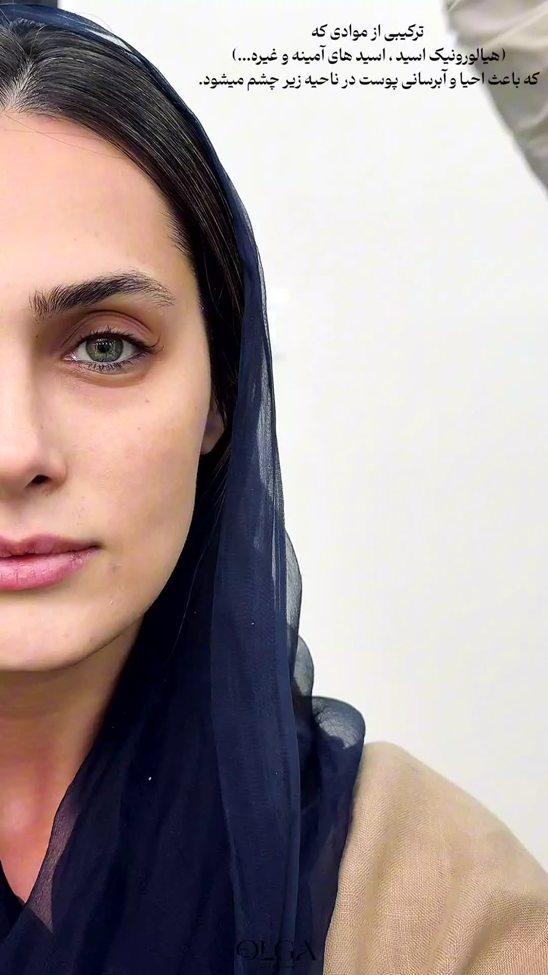 مزوتراپی زیر چشم