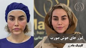 جای جوش‌هات هنوز روی صورتت مونده؟ ( کلینیک ماه زر - دکتر میثم ضرغامی )