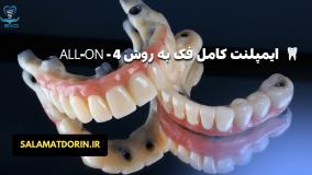 ایمپلنت کامل فک به روش All-On-4 | سلامت کاشت درین 3A