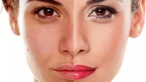 درمان تیرگی نواحی خاص پوست