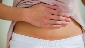 درمان اسکار سزارین