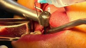 ایمپلنت دندان در تهران مطب دکتر حمید پورصادقی