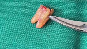 ایمپلنت دندان تمام فک اقساطی در تهران