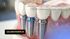 ایمپلنت دندان را با یک عمل جراحی میتوان کامل کرد؟|سلامت کاشت درین