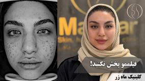 ۶ ماه بعد از درمان اسکار آکنه 🔍 ( کلینیک ماه زر - دکتر میثم ضرغامی )