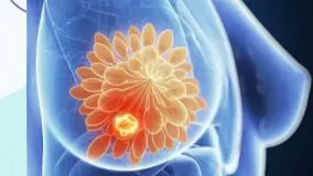 علل ایجاد سرطان پستان