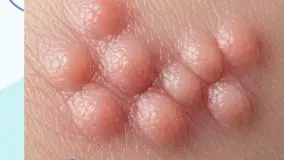 اگر زگیل‌ها را برداریم زیاد می‌شود؟