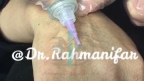 درمان چین و چروک های پشت دست با دستگاه پزشکی Carboxy Therapy