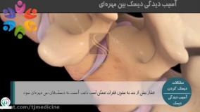 معافیت دیسک گردن پدر