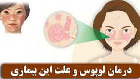 درمان قطعی و بدون بازگشت لوپوس