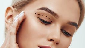 بلفاروپلاستی