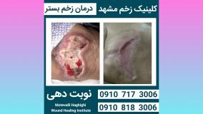 درمان زخم بستر | مشهد | کلینیک دکتر زخم مشهد