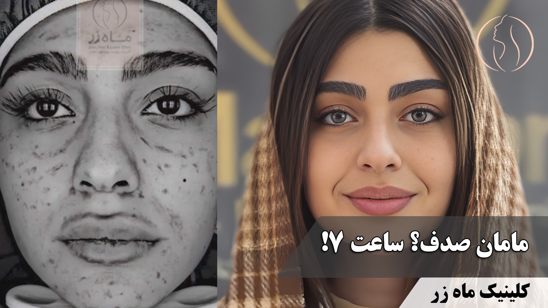 🤔 چند جلسه ؟۴ ساعت! ( کلینیک زیبایی ماه زر )
