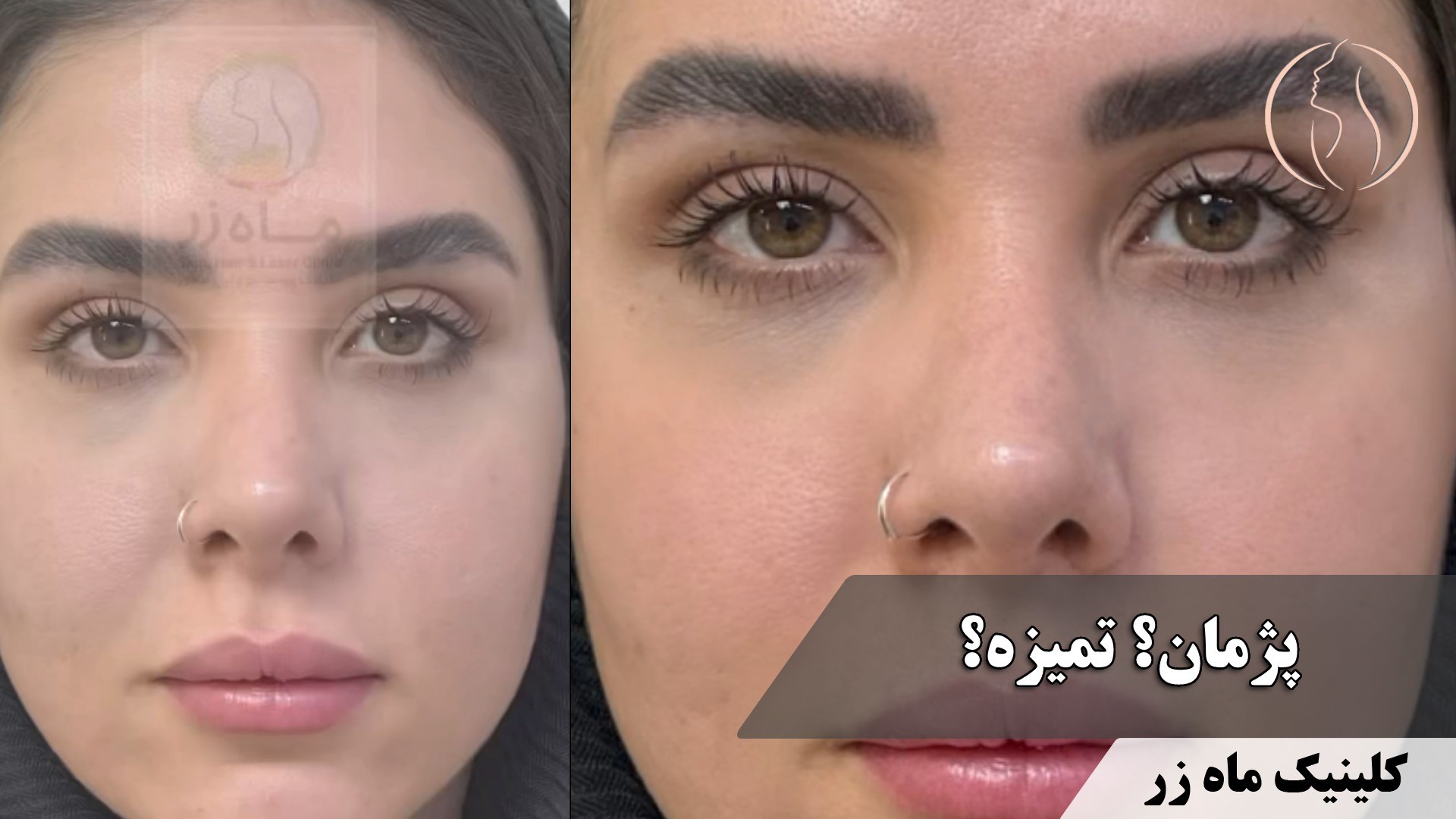 پوست صاف بدون اسکار ( کلینیک زیبایی ماه زر )